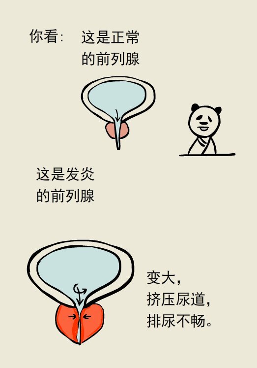 前“腺”危机—您的前列腺炎为何这么难治?