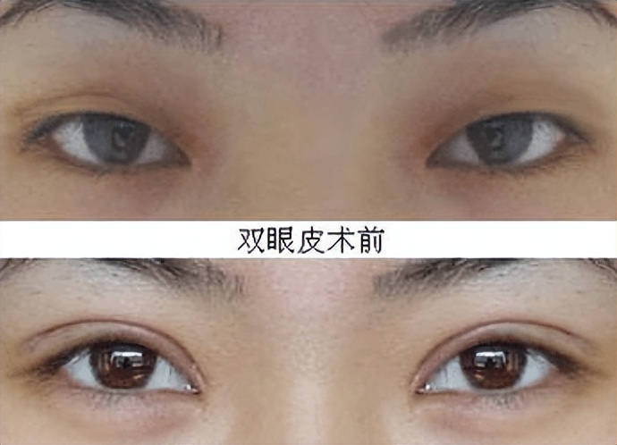 修复双眼皮七个月了人都说失败了,双眼皮失败修复的亲身经历