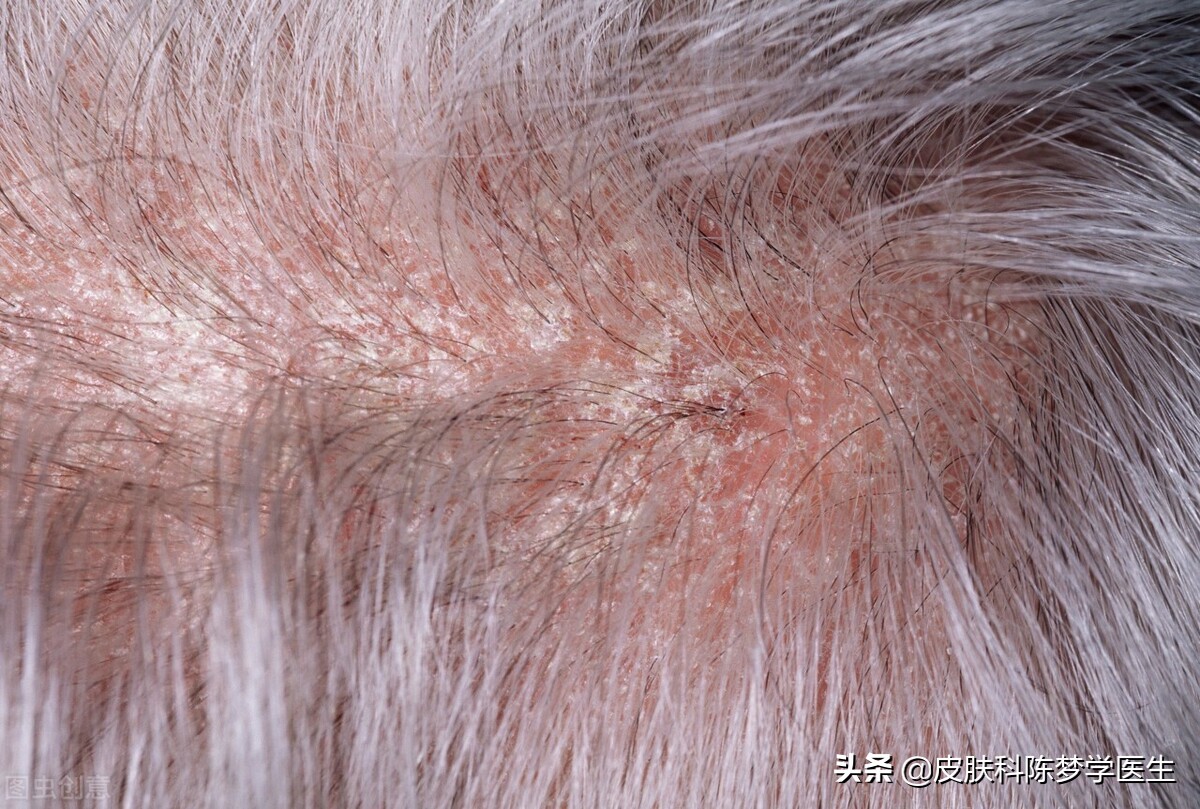 脸上红斑痒起皮屑是红斑狼疮吗,脸上有银屑病红斑怎么办