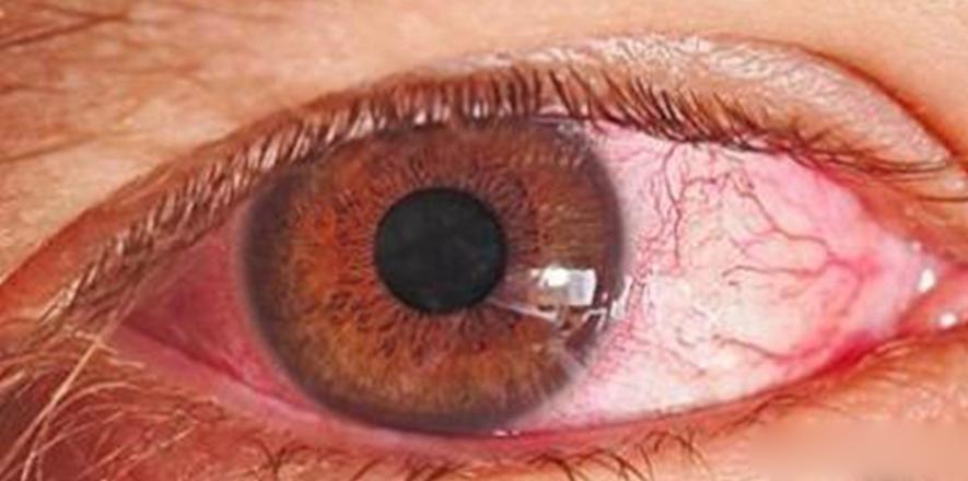 肝火胃火口舌生疮吃什么药,口舌生疮是有胃火肝火还是有肺火