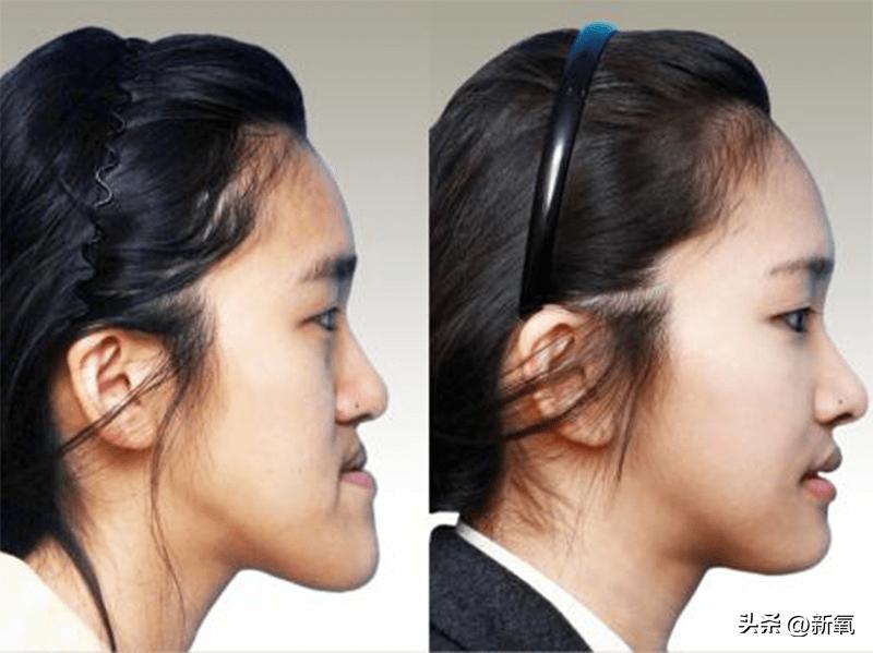 牙齿正畸和骨骼正畸的区别,牙齿正畸和眼轴增长有关系吗