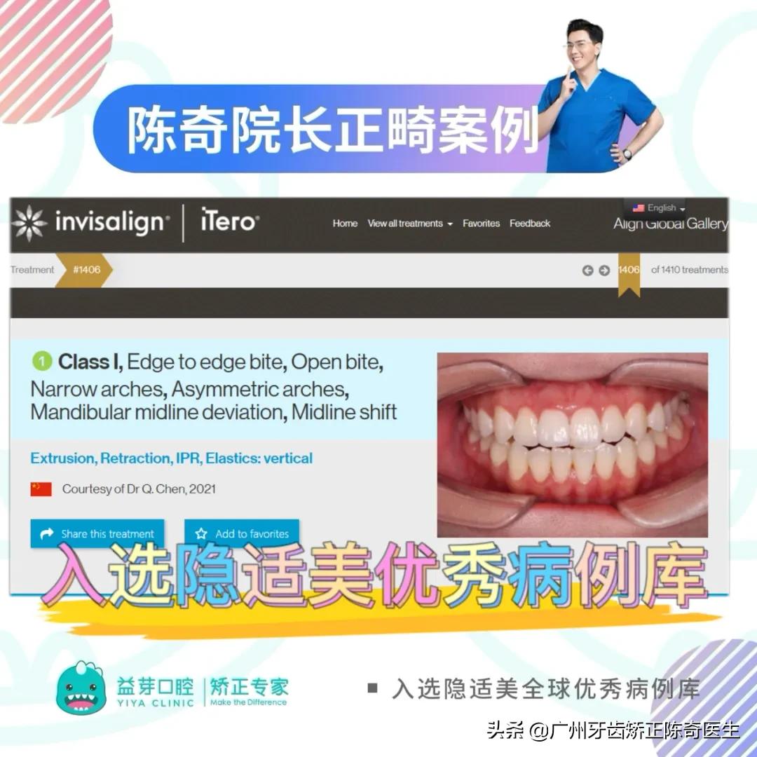 隐适美矫正和普通矫正的区别,隐适美矫正有几种版本