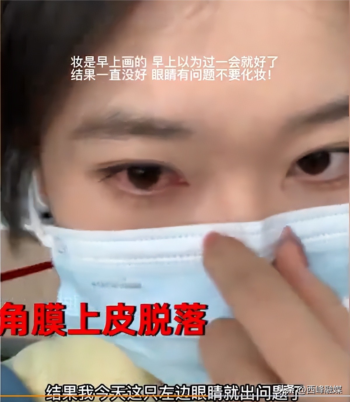 女生熬夜打游戏角膜上皮脱落!医生称严重需手术换角膜:一定要控制