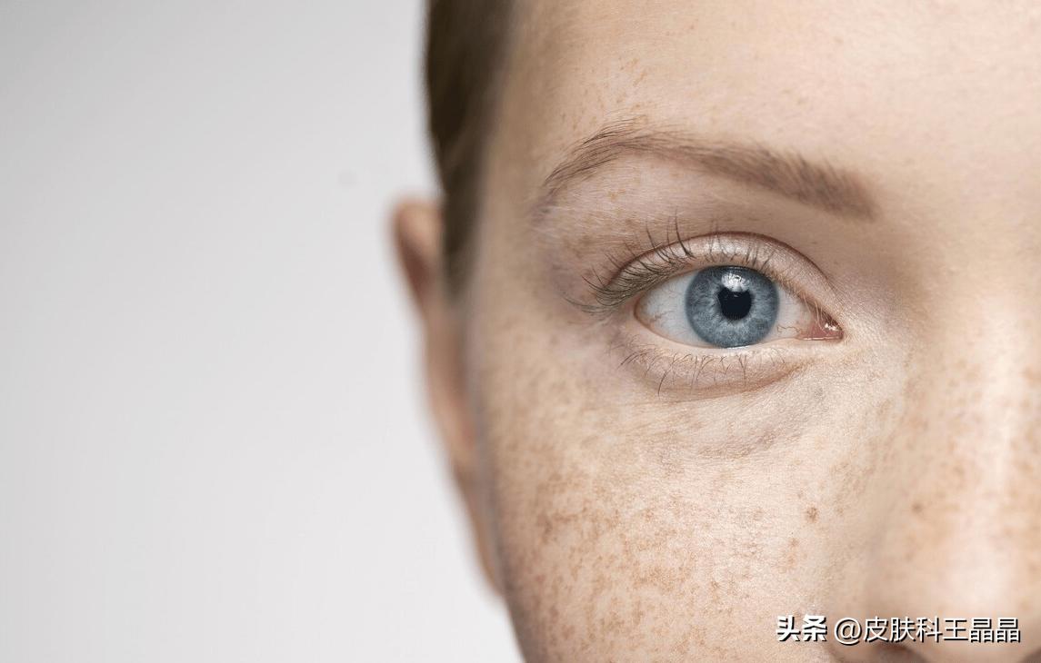 色斑用任何方法都祛不掉怎么办,色斑应该治吗