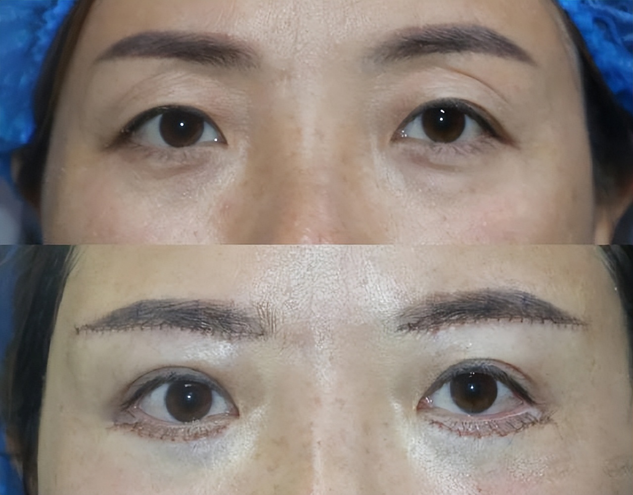 做过提眉术的感觉怎样,做提眉的亲身经历