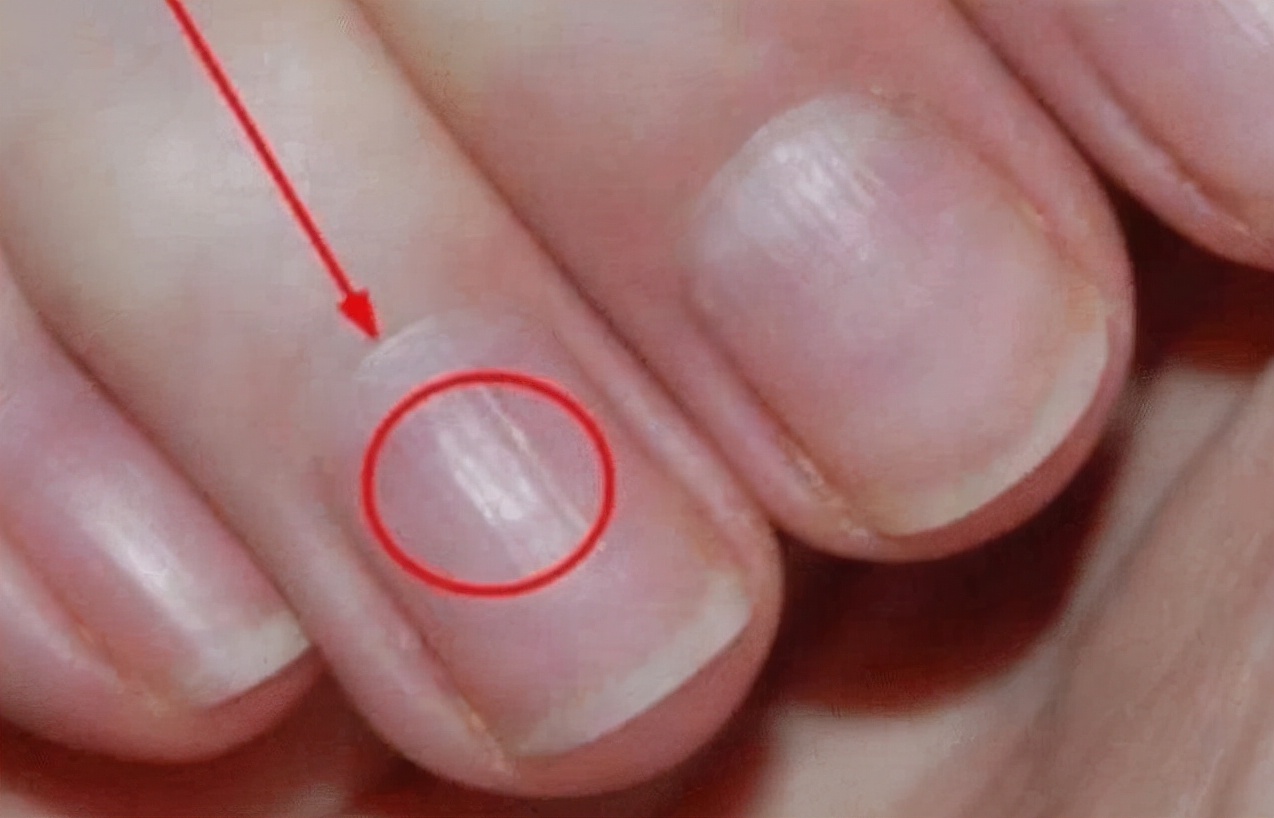 指甲有竖条纹是什么病,指甲有竖条纹的原因和危害