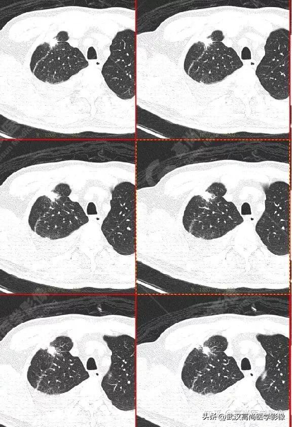 10毫米的肺结节恶性死亡率有多大,1厘米多的肺结节良性可能性多大