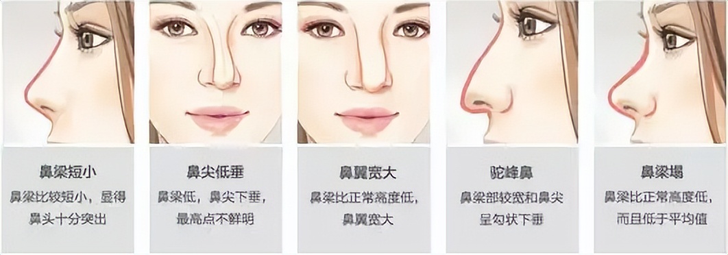 上海九院韦敏隆鼻,九院韦敏技术怎么样