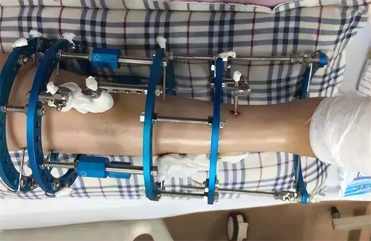 断骨增高的李亚诺是哪里人,李亚诺截骨长高是真人真事吗