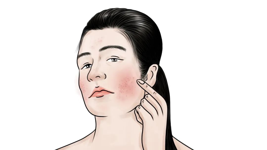 盘点！药疹的发病机制和6种常见药疹类型，看完你会有所收获