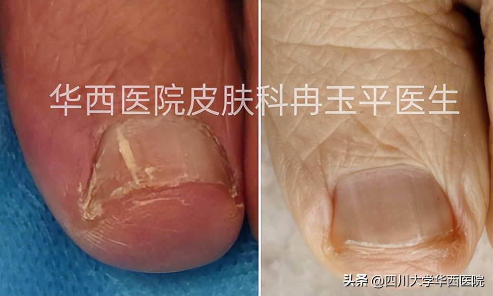 灰指甲是指甲发灰吗,指甲灰色就是灰指甲吗