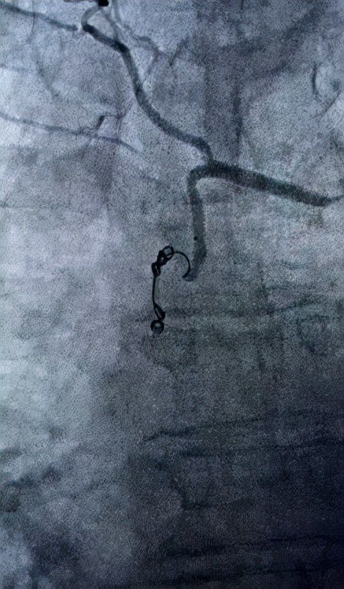 支气管动脉栓塞最严重术后并发症,支气管扩张并咯血的介入栓塞治疗