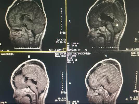 七岁男孩新长出的牙齿都有锯齿,7岁男孩朝上长一颗牙