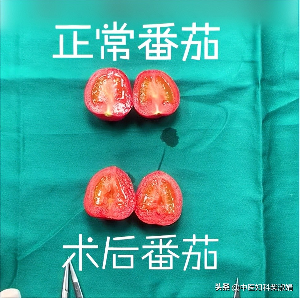 一组图，揭秘人流后的子宫状态，结果太直观了