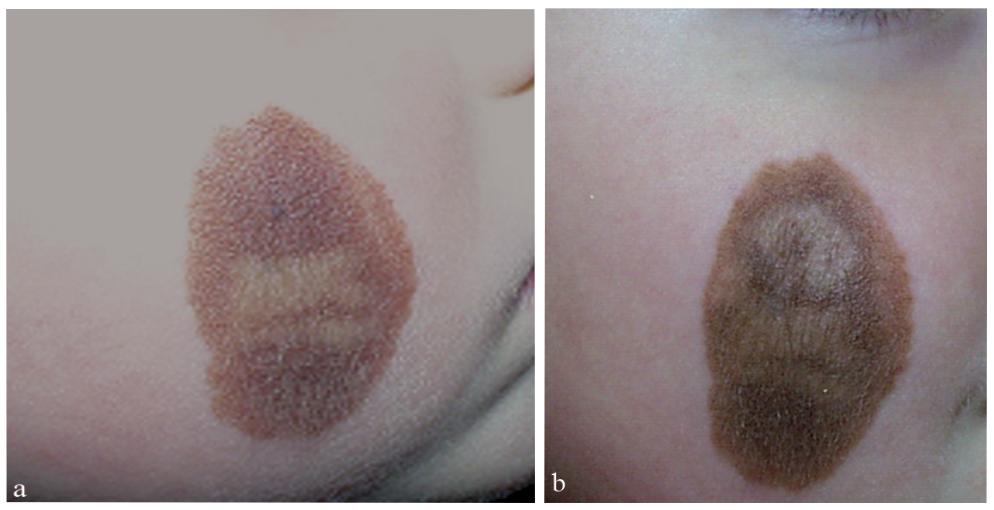 痣变黑变大是癌变了还是癌前病变,背上长了个肉痣是癌的象征吗