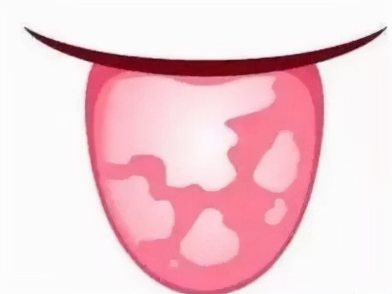 地图舌头要不要治疗,地图舌头的治疗方法