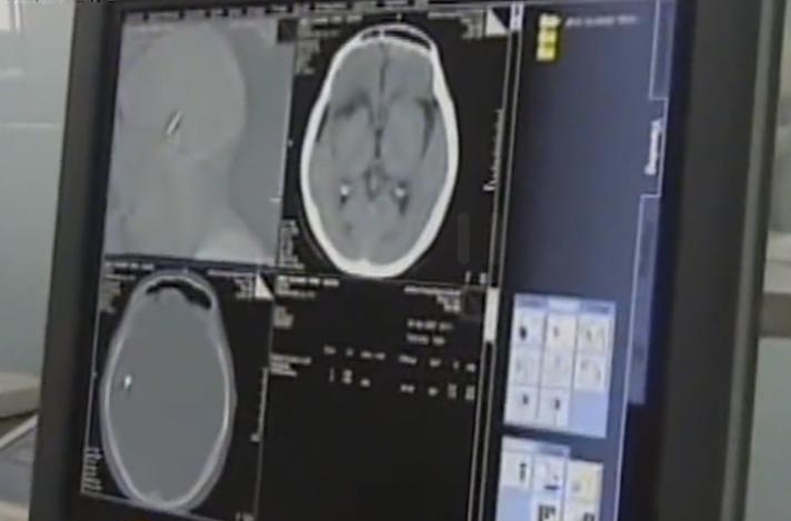 故事:江苏70岁老人头疼欲裂,检查时发现颅内有*弹子**,吓坏在场医生