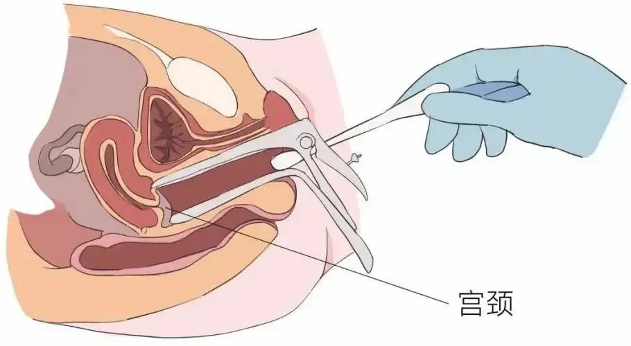 宫腔中下段妊娠会粘连吗,怀孕后宫腔粘连有影响吗