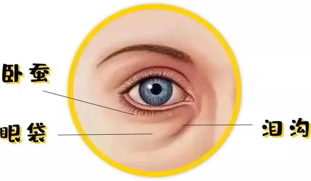 眼袋卧蚕泪沟同时具备是什么样子,卧蚕和眼袋泪沟可以一起做吗
