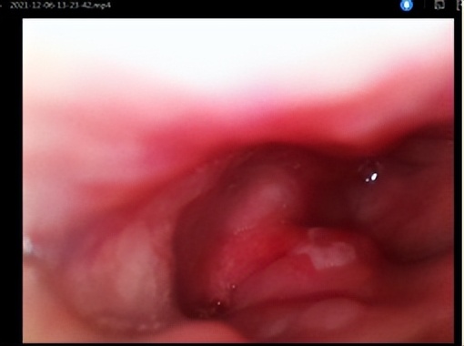 鱼刺卡喉求医6次,记录求医之路