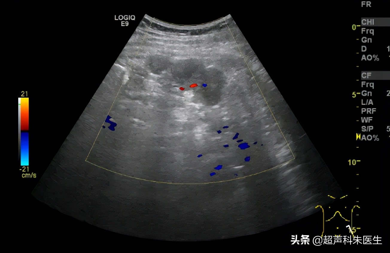 盆腔左侧包块是肿瘤吗,发现肿块需要重视而非高度紧张
