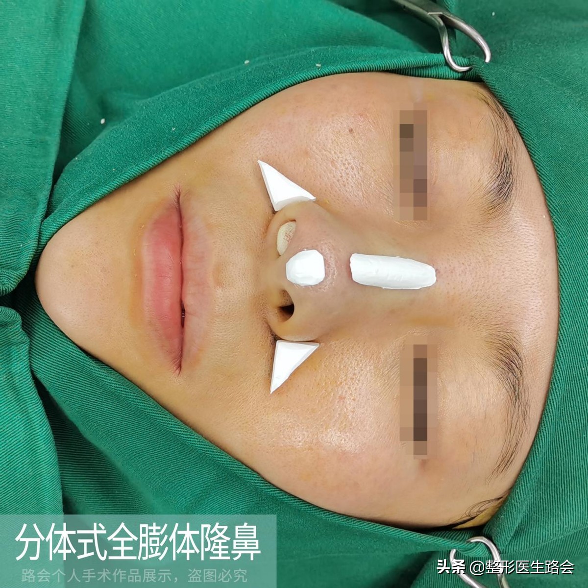 鼻基底填充法令纹瞬间消失,鼻基底填充后法令纹能改善多少