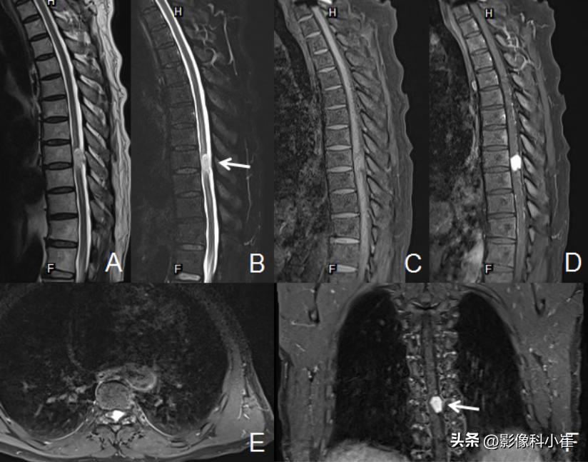 血管瘤病历单图片,海绵状血管瘤病历模板
