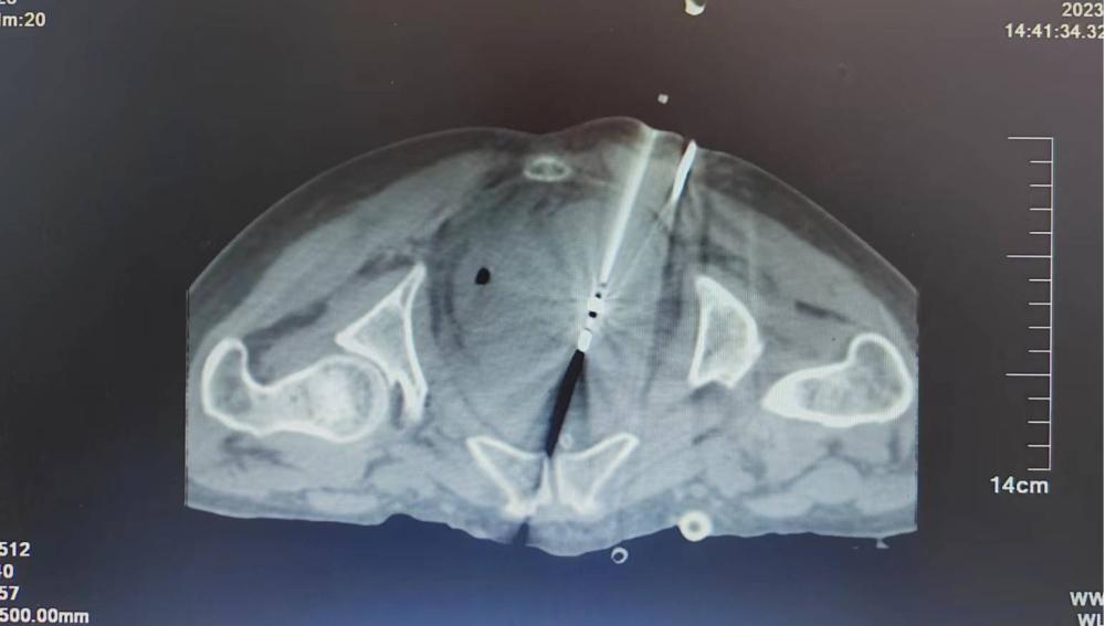 不能忍受的“癌痛”应该怎么缓解？