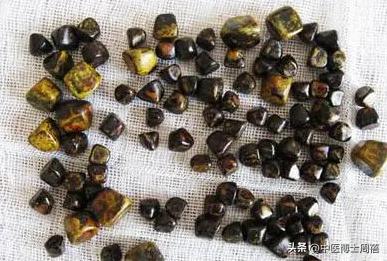 胆结石服用中药可以排出来吗,胆囊息肉结石可以用中药来治疗吗