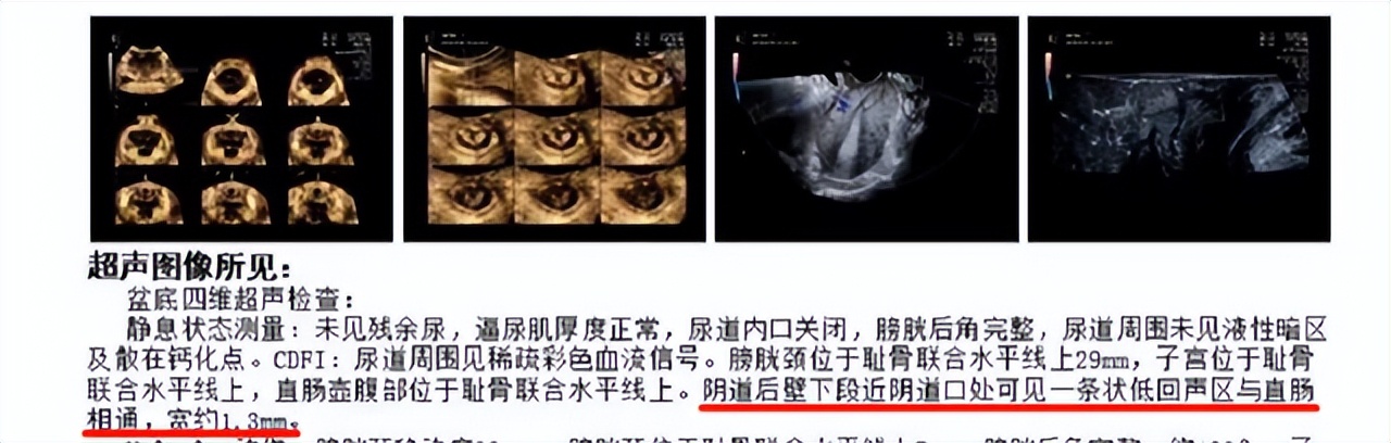 产后20天排出一坨像肠子一样东西,产后第一次大便是墨绿色的