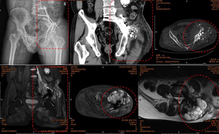 骨肿瘤骨盆重建手术,骨肿瘤多处转移还能治愈吗