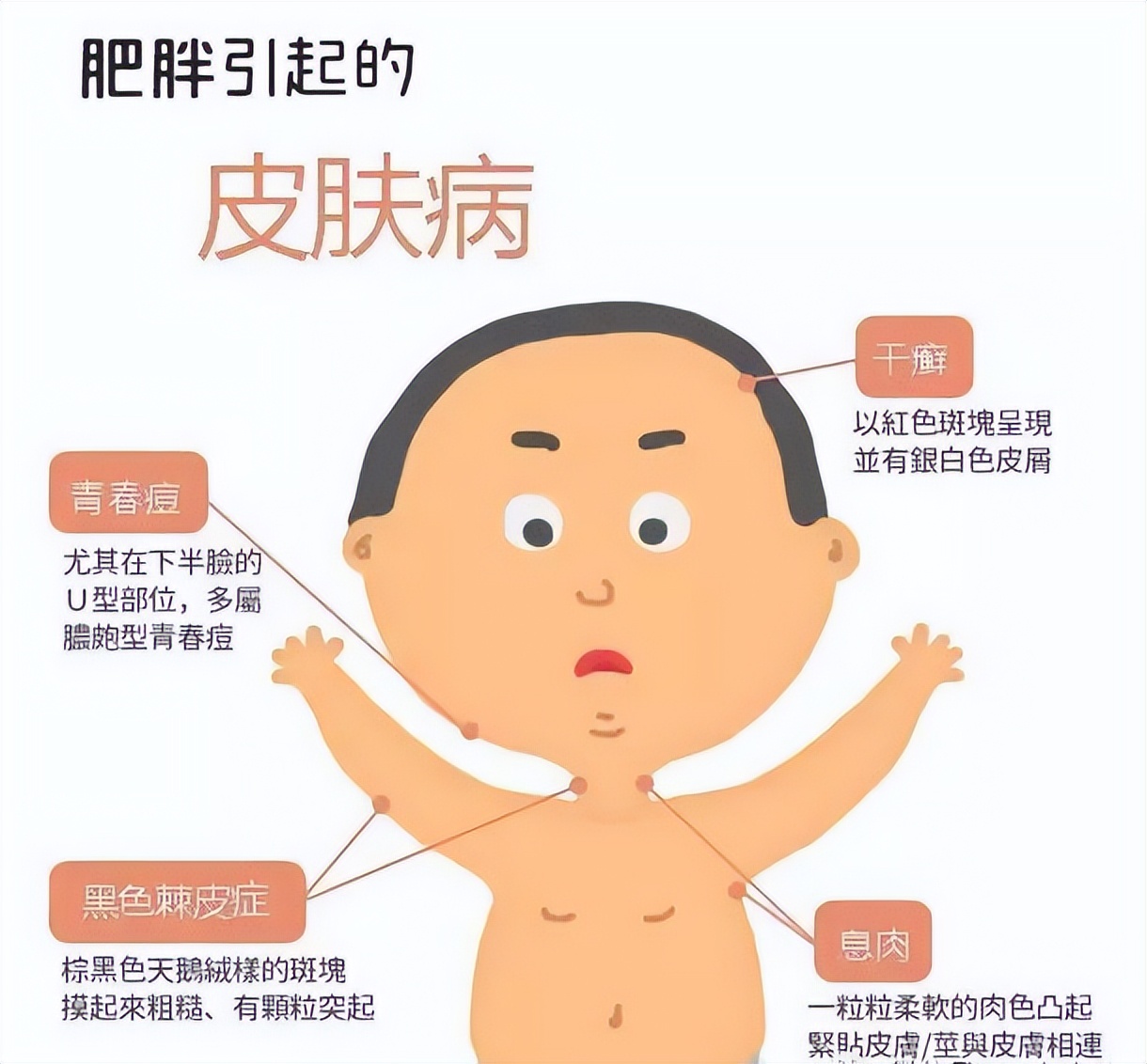 黑棘皮病，揭开你神秘的面纱