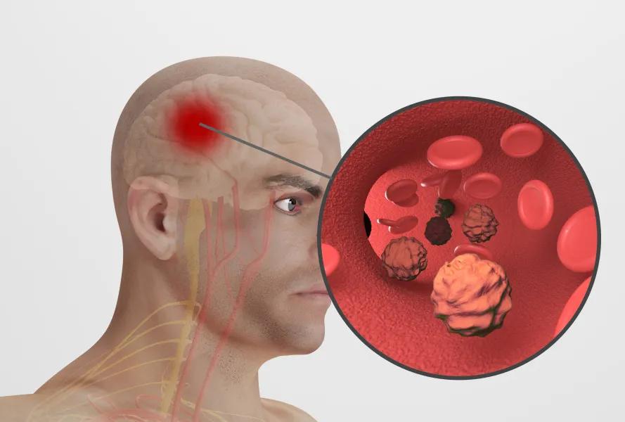 动脉瘤是不是癌症啊,动脉瘤是发生在动脉的良性肿瘤吗