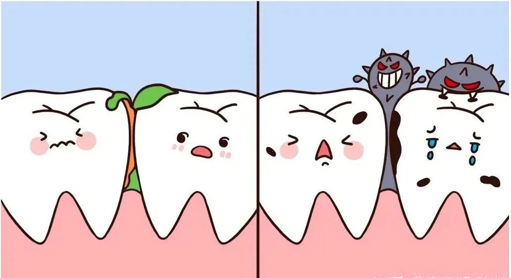 口腔中的隐身高手——邻面龋？