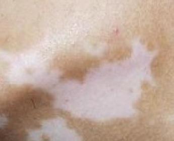 二十岁花季少女毁容手术,重庆15岁花季少女被毁容之后