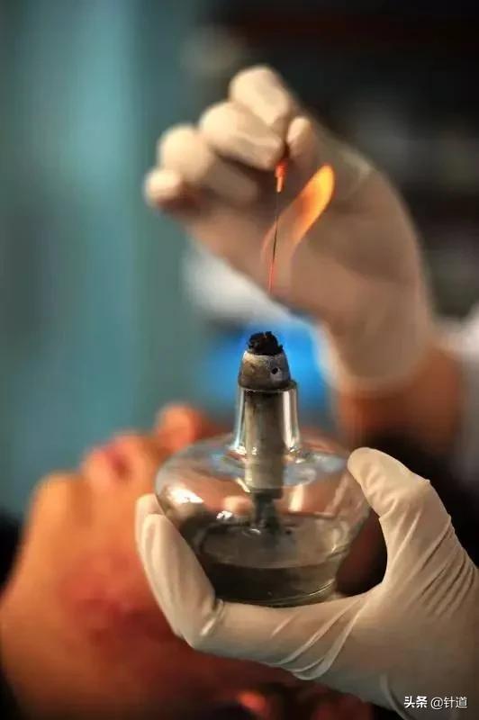 贺普仁的贺氏针灸三通法详解,针灸贺普仁