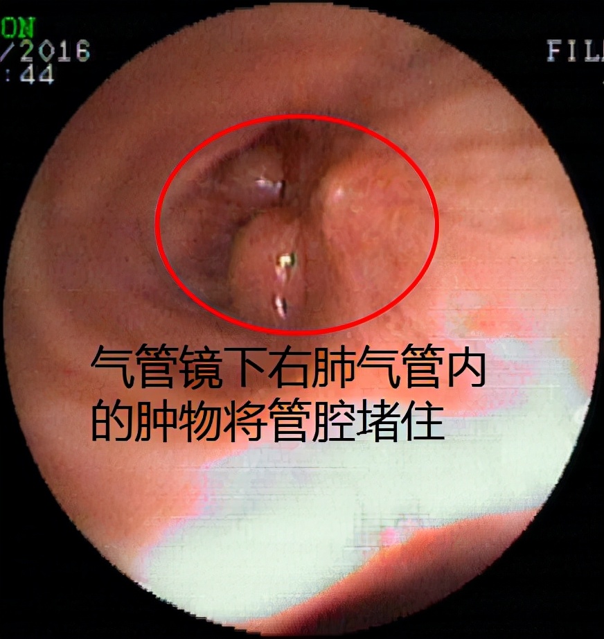 气管镜下肿瘤怎么治疗,气管肿物是什么