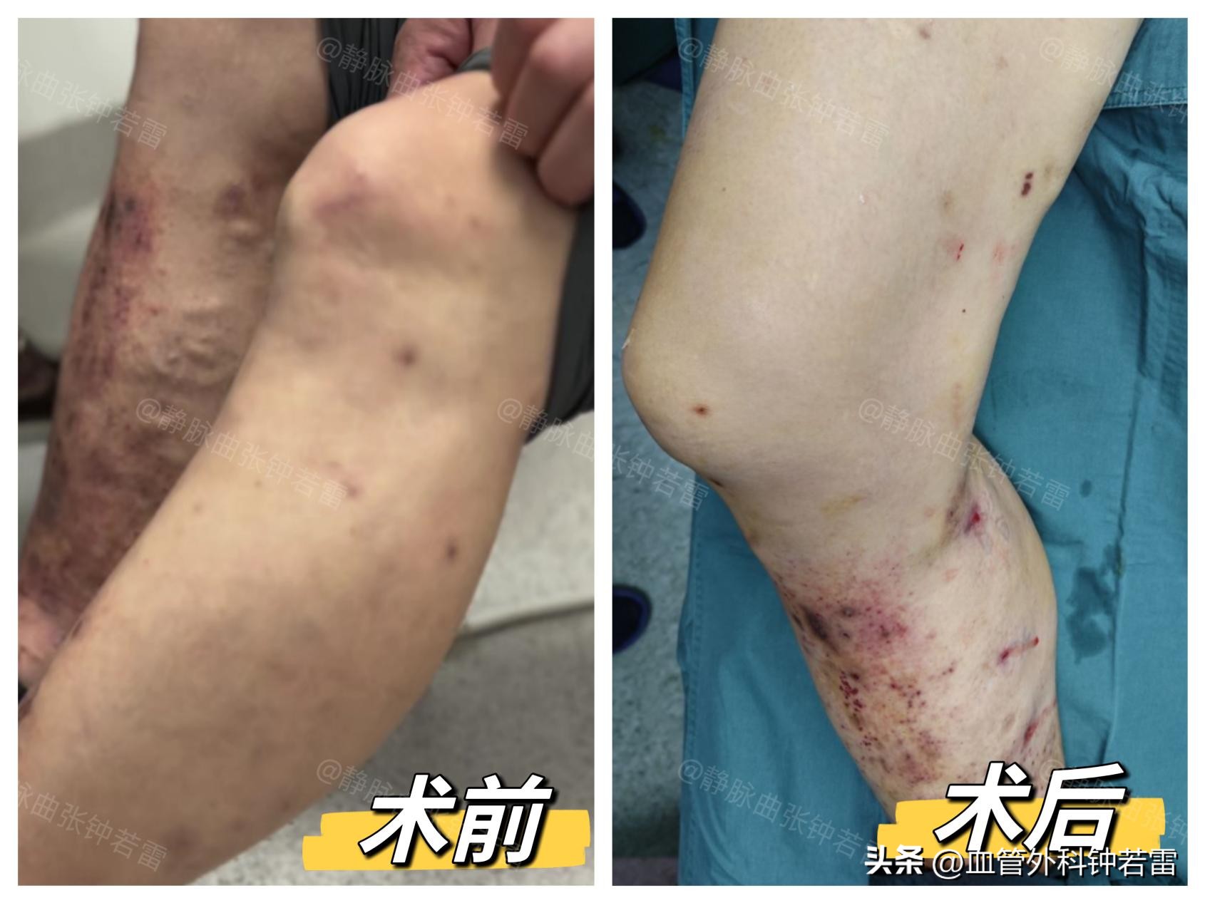 中度精索静脉曲张吃药能治疗好么,双侧精索静脉曲张3.0吃药能好吗