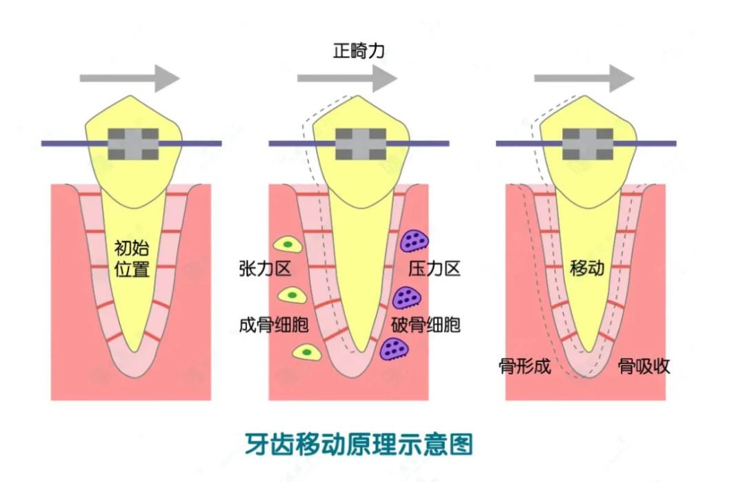 正畸治疗须知,正畸有哪些注意事项