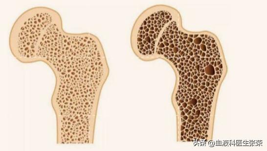 为什么治疗紫癜要用激素,血小板减少紫癜吃激素能治愈吗