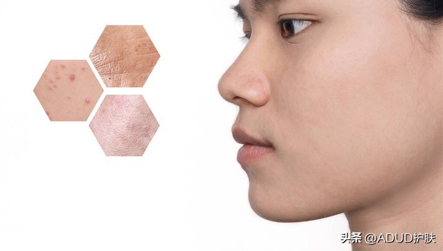 痘痘不挤自己会好吗,痘痘抠成增生了