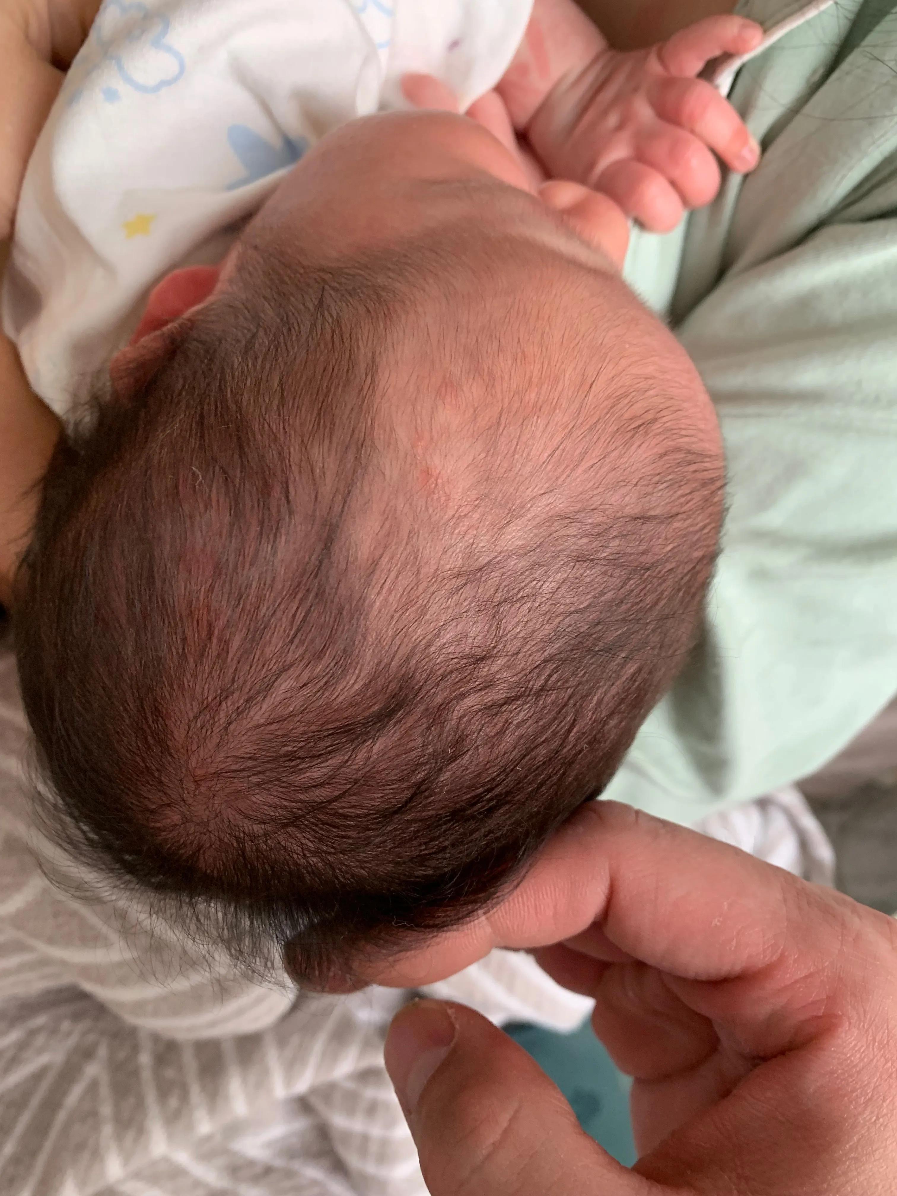 满月婴儿湿疹挂什么科,满月婴儿长湿疹抹什么药膏