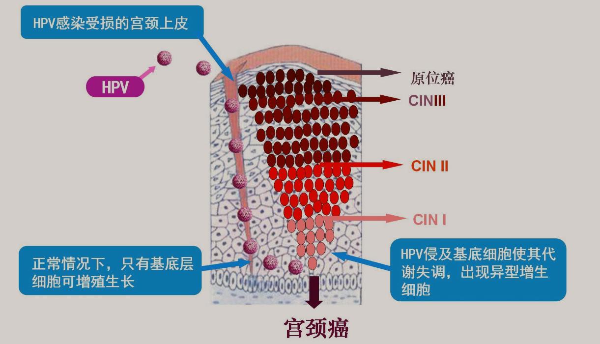 45岁女子感染HPV，3个月*处私**长满“痘痘”！下身4种异常别再轻视