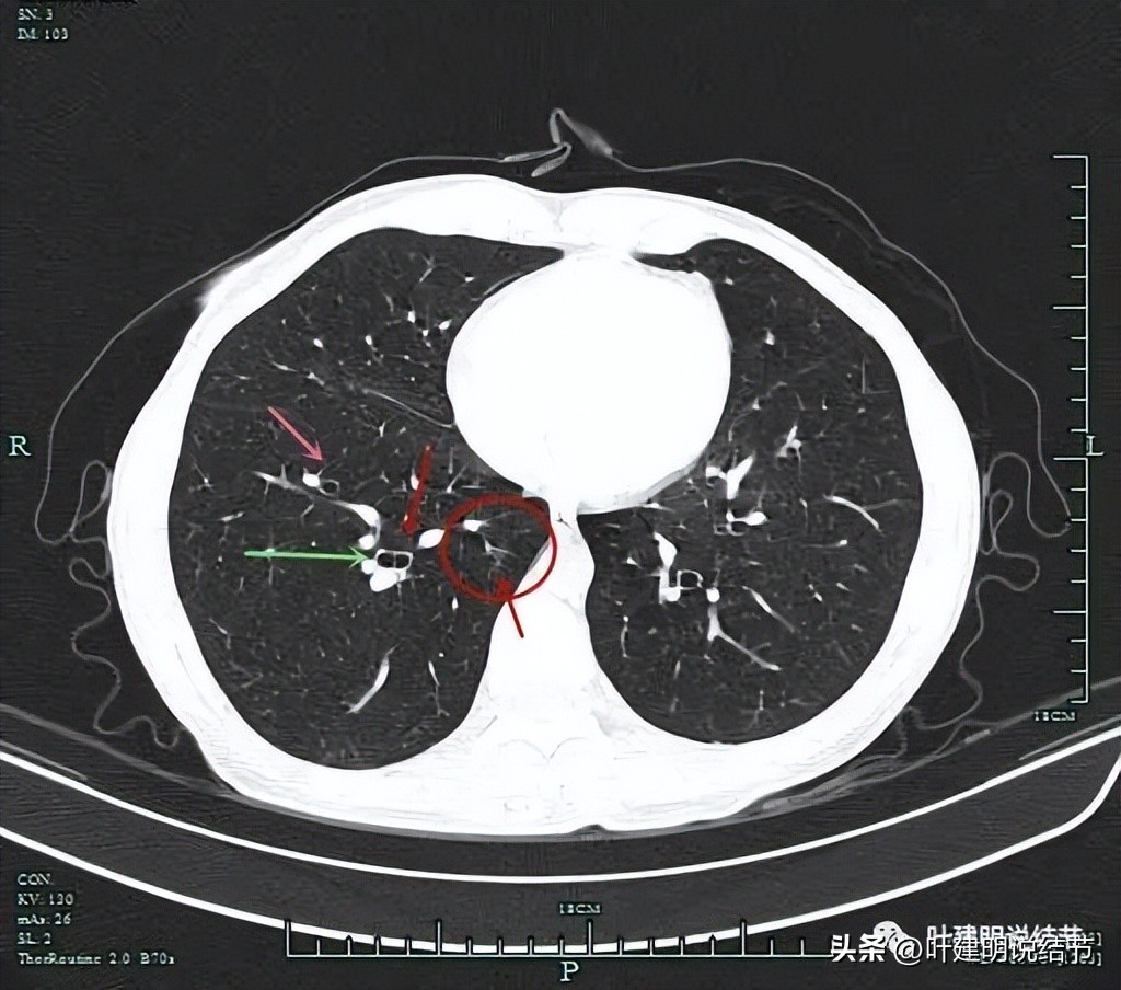 右下叶磨玻璃结节5*4,右下叶磨玻璃样结节多为炎性