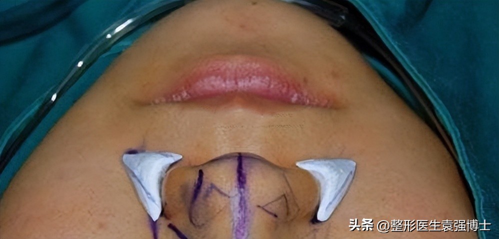 治法令纹有什么妙招,有法令纹做什么效果比较好