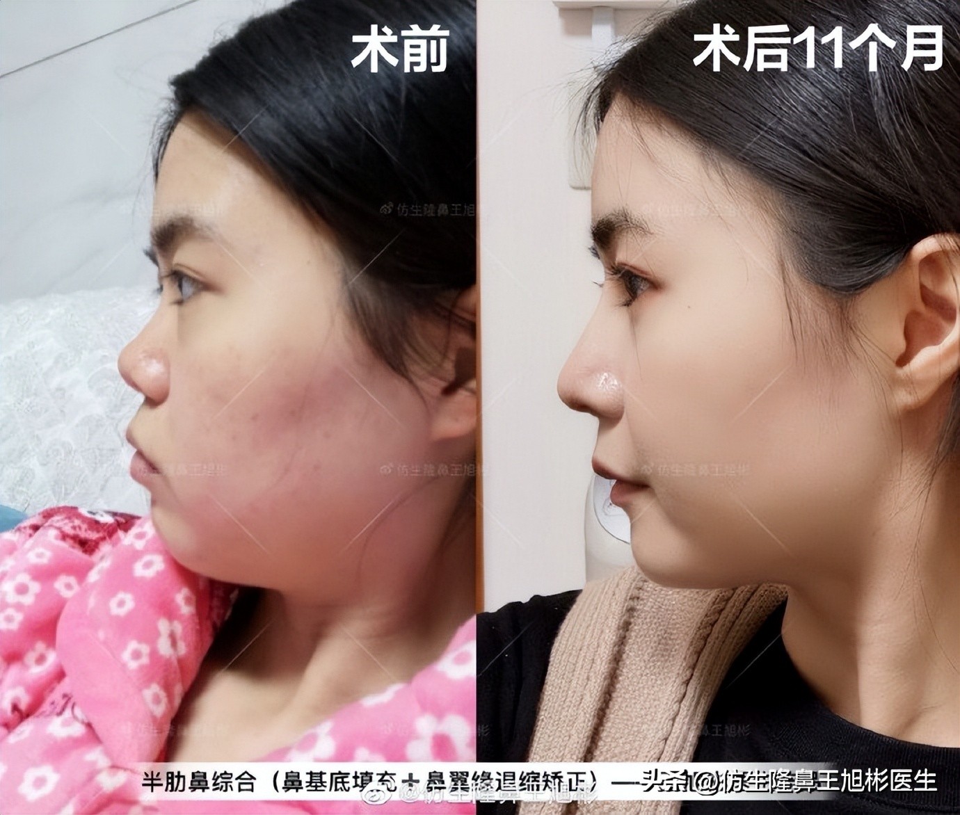 隆鼻鼻型科普,鼻基底凹陷隆鼻可以改善吗