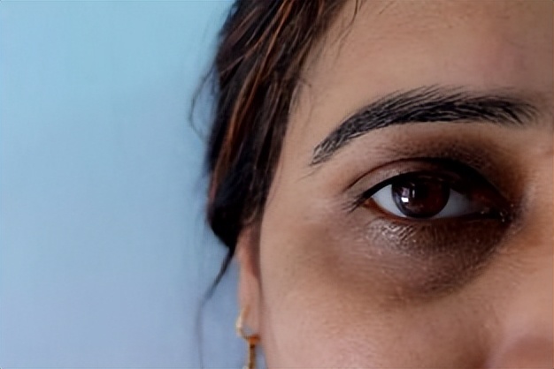 眼睛眼袋水肿并且痛,水肿型眼袋是水喝多了吗