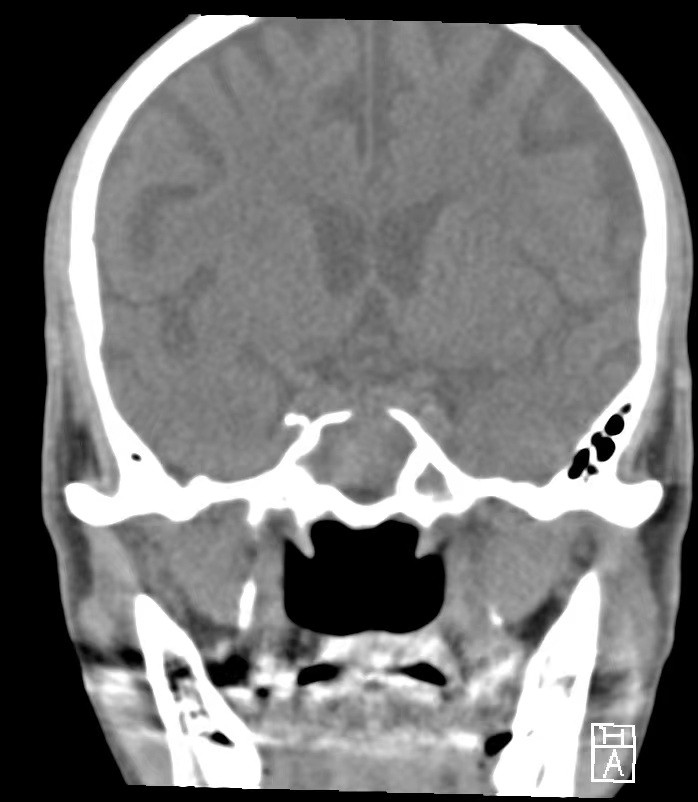 耳鼻喉手术上午手术下午出院,外科手术第二天出院