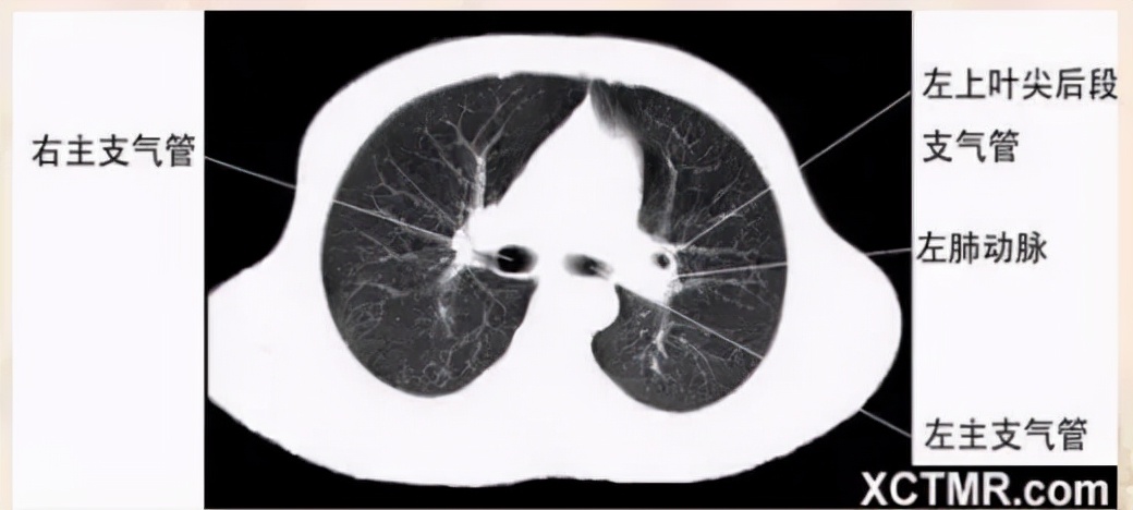 胸腹部盆腔ct主要检查什么,女性盆腔ct断层解剖结构图