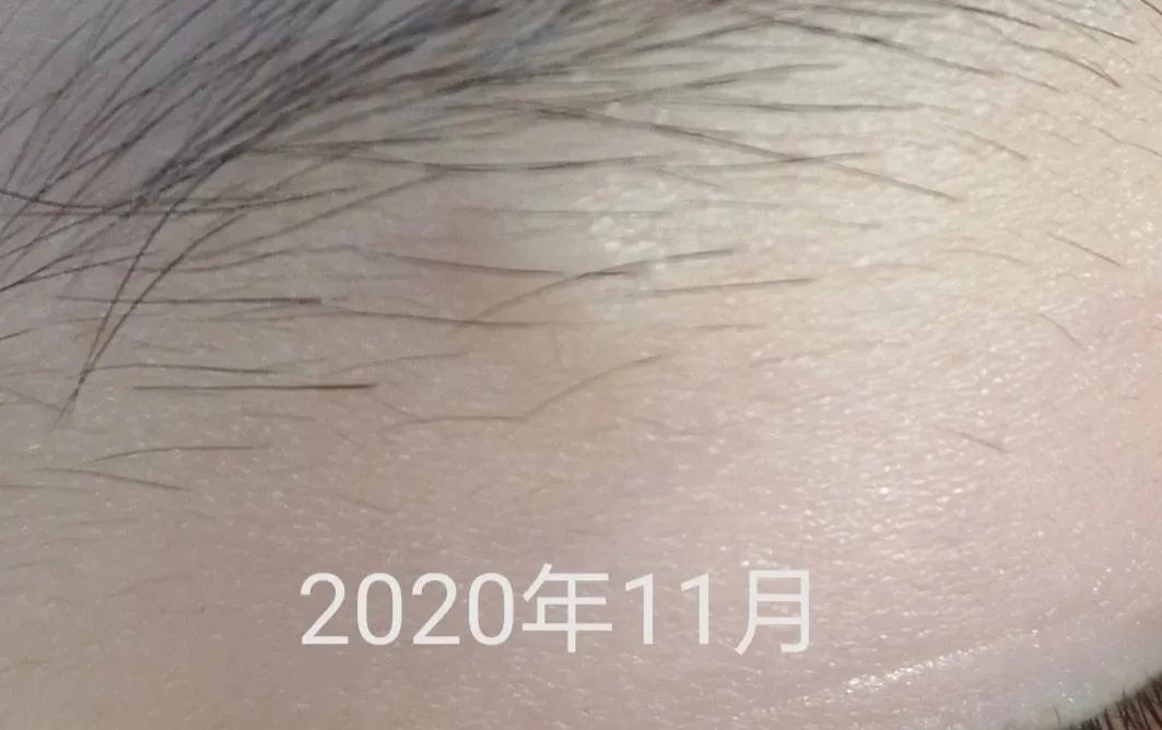 皮脂腺囊肿挤出囊袋,皮脂腺囊肿切除手术